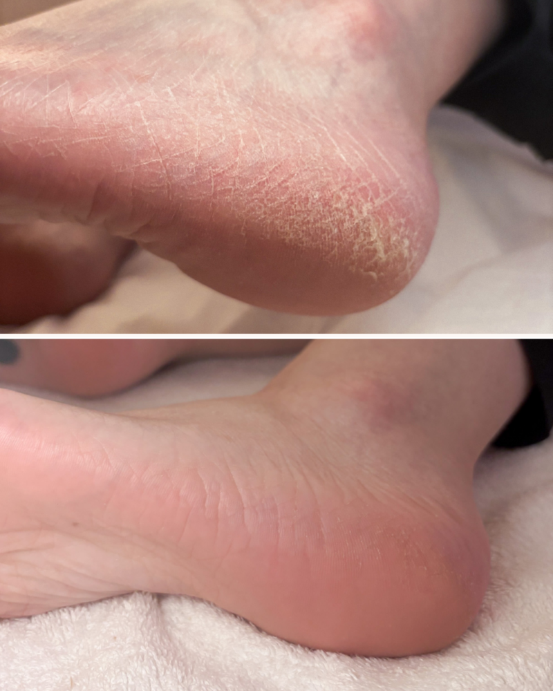 Article Calluspeeling L’OFFRE DE L’ÉTÉ : CALLUSPEELING + POSE DE SEMI PERMANENT